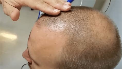 Review Of Stem Cell Hair Transplant For Baldness The Niche