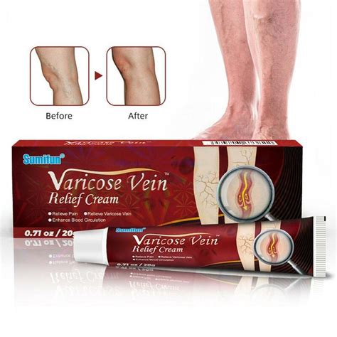 G Varicose Veins Ointment Vein Relief Relieve Leg Bulging Calf