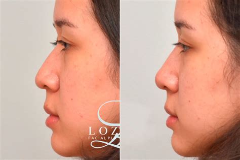 Liquid Rhinoplasty Photos Philadelphia Pa Patient 1293