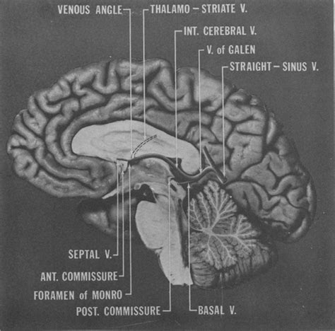 Identification Of The Anterior And Posterior Commissures By Angiography