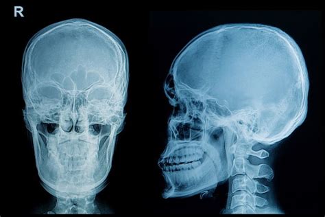 Como identificar e tratar uma fratura no crânio Tua Saúde