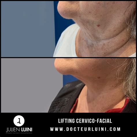 Lifting du visage en images Docteur Luini Chirurgie esthétique