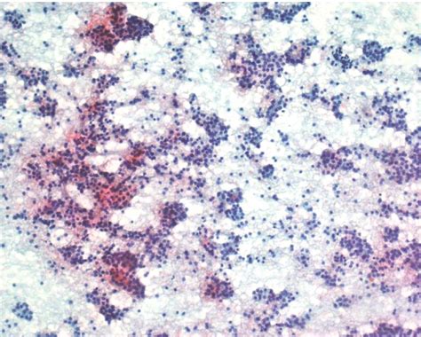 Figure 10 From A Comparative Study Of Fine Needle Aspiration Cytology