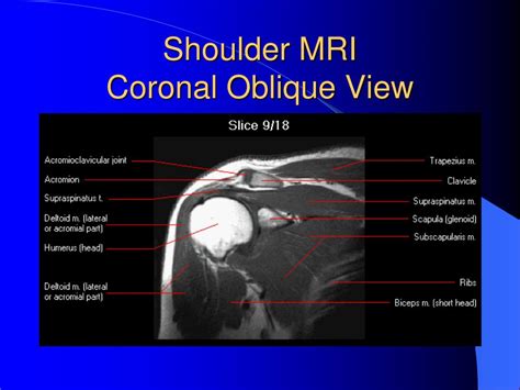 Axial MRI Shoulder Anatomy