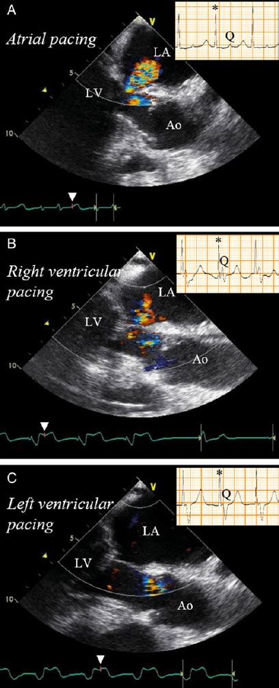 Mitral Regurgitation And Intraoperative Echocardiograms With Differ