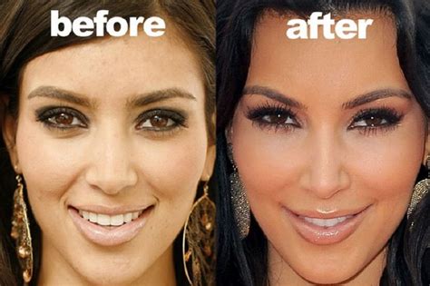 Kim Kardashian plastic surgery allegations