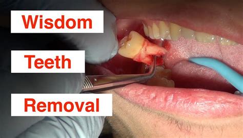 Wisdom Tooth Extraction