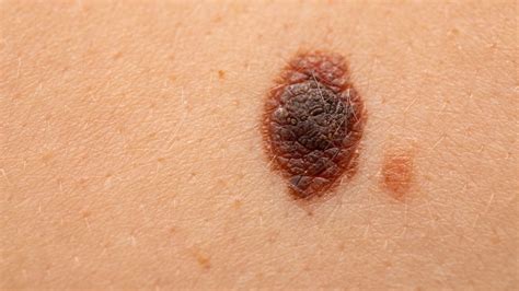 qué Es El Cáncer De Piel Tipo Melanoma Medicina Básica Free Download