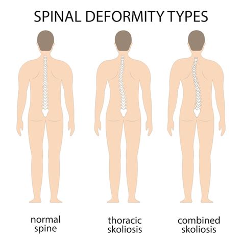 Premium Vector Vector Illustration Of Spinal Deformity Kyphosis