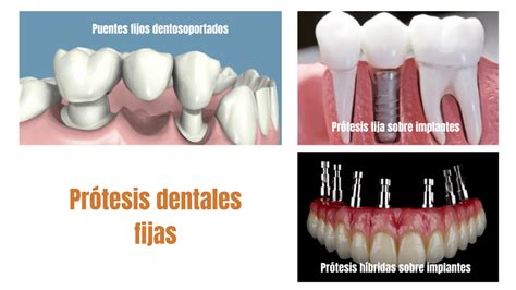 Diferencias entre puentes e implantes dentales Dental Barón Clínica