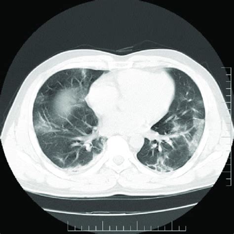 Chest CT Scan Of First Patient Showing Diffuse Patchy Bilateral Ground