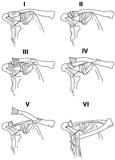 Acromioclavicular Joint Separation Treatment