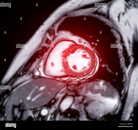 Mri Heart Or Cardiac Mri Magnetic Resonance Imaging Of Heart For