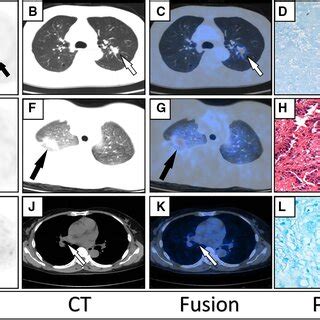 Ad Axial Pet Ct Fused Pet Ct And Pathology Images Of A