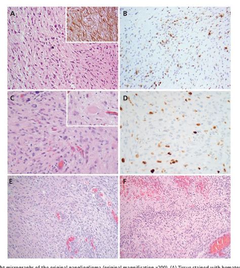 Figure From Personalized Treatment For A Patient With A Braf V E