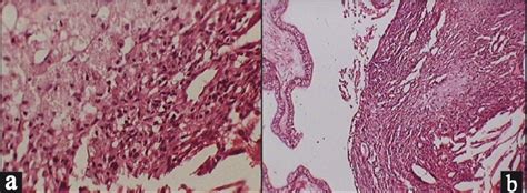 Unusual Presentation Of Xanthogranuloma Of The Choroid Plexus Journal
