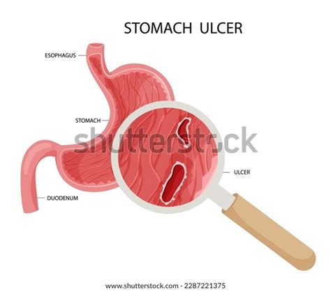 Peptic Ulcer Stomach Under Magnifying Glass Stock Vector Royalty Free