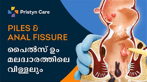 Piles Anal Fissure Treatment In Malayalam Pristyn Care For Free Appointment Call 9821 388