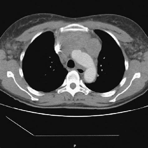 Classification Of Germ Cell Tumors Of The Mediastinum Download