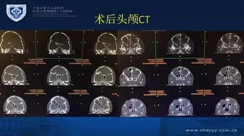 颅脑创伤 神经重症病例周刊第25期丨小儿合并严重颌面部外伤的开放性脑外伤治疗一例 脑医汇 神外资讯 神介资讯