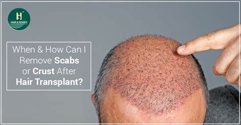 When And How Can I Remove Scabs Or Crust After Hair Transplant