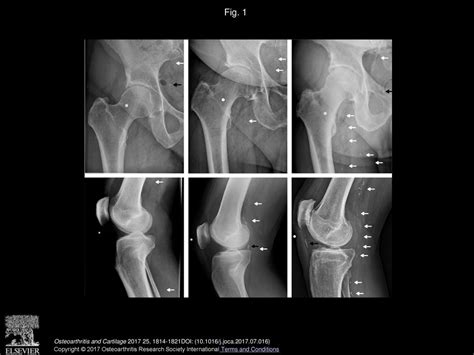 A Sex Specific Association Between Incident Radiographic Osteoarthritis