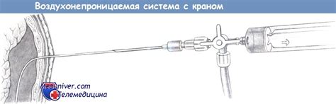 Показания и техника пункции плевральной полости
