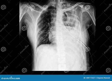 Multiple Rib Fractures With Hemothorax Stock Image Image Of Bone