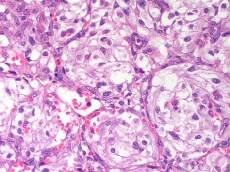 Carotid Body Tumor Pathophysiology Wikidoc