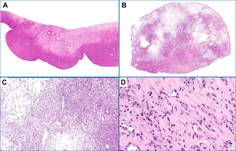 Update On Ovarian Sex CordStromal Tumors Surgical Pathology Clinics