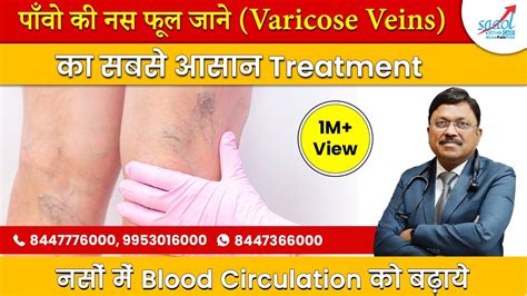 पव क नस फल जन Varicose Veins क सबस आसन Treatment Dr