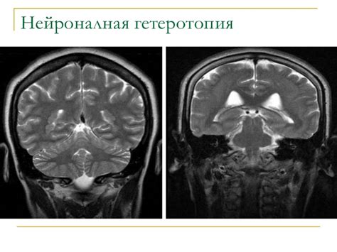 Гетеротропия фото