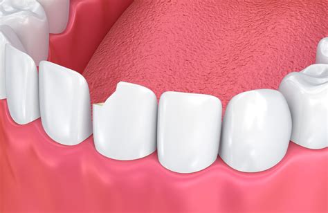 What Causes Teeth To Chip Nashville Tn Clint Newman Dds