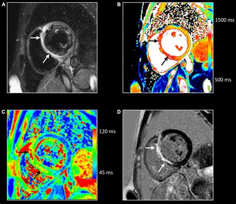 Frontiers Role Of Cardiovascular Magnetic Resonance To Assess Cardiovascular Inflammation