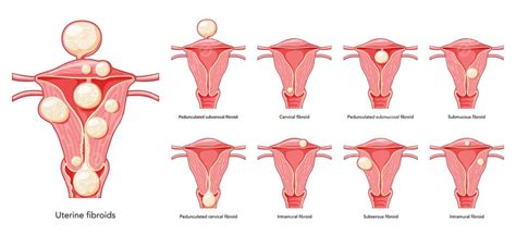 Fibromi Uterini Nel Problema Di Anatomia Del Sistema Riproduttivo