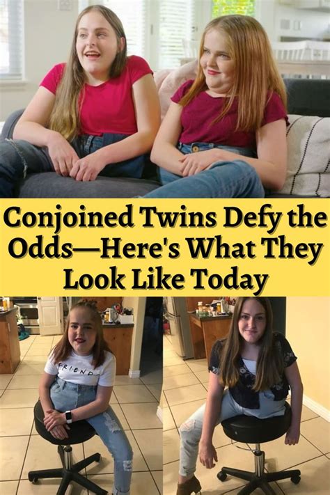 Conjoined Twins Defy The Odds—heres What They Look Like Today In 2023 Celebrity Facts