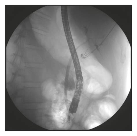 A Ercp With Cholangiogram With Normal Cbd And No Residual Stricture Download Scientific