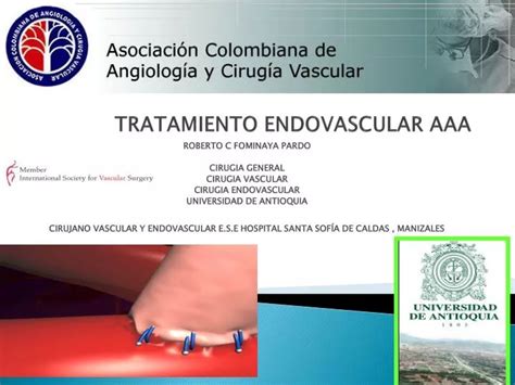 Ppt Tratamiento Endovascular Aaa Powerpoint Presentation Free