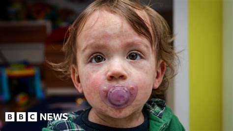 London Measles Warning Outbreak Could Hit Tens Of Thousands Bbc News