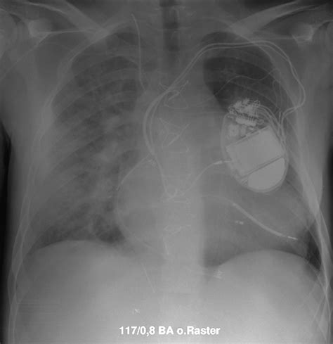 Failing Mustard Circulation With Secondary Pulmonary Hypertension