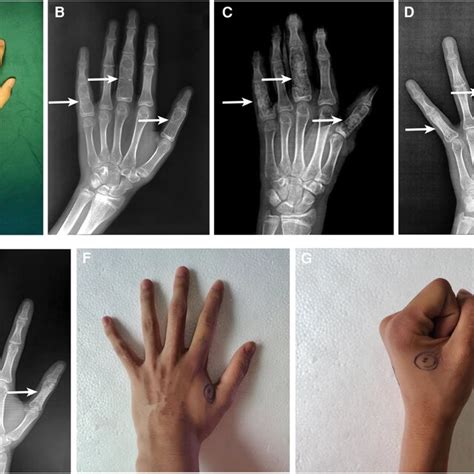 Clinical And Radiographical Results Before And After Surgery Of The