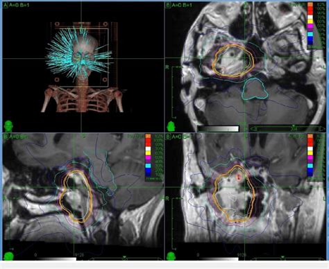 The Stereotactic Body Radiation Therapy Treatment Plan For The Primary