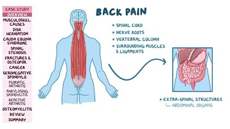 Back Pain Pathology Review Video Anatomy Osmosis