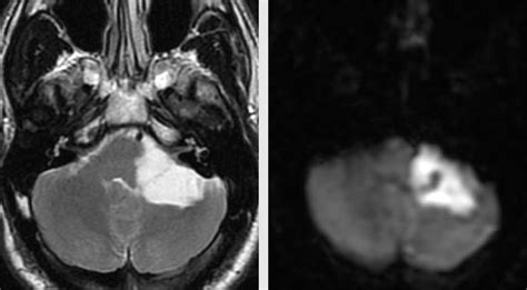 Epidermoid Cyst Brain Mri