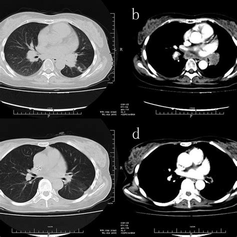 Ct Scan Of The Chest Revealed A Lobulated Nodular Lesion In The Left