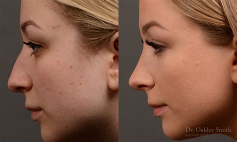 Rhinoplasty Before After Case 454 Toronto Rhinoplasty Surgery Nose