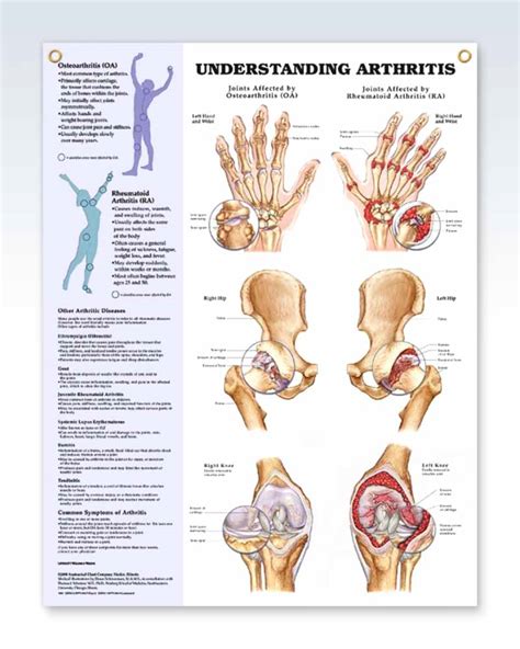 Arthritis Exam Room Anatomy Poster Clinicalposters