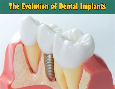 Implantology The Evolution Of Dental Implants