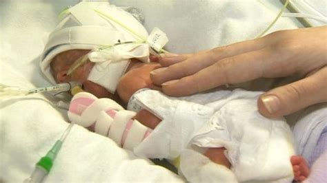 Severely Premature Babies More Survive Being Born Early Bbc News