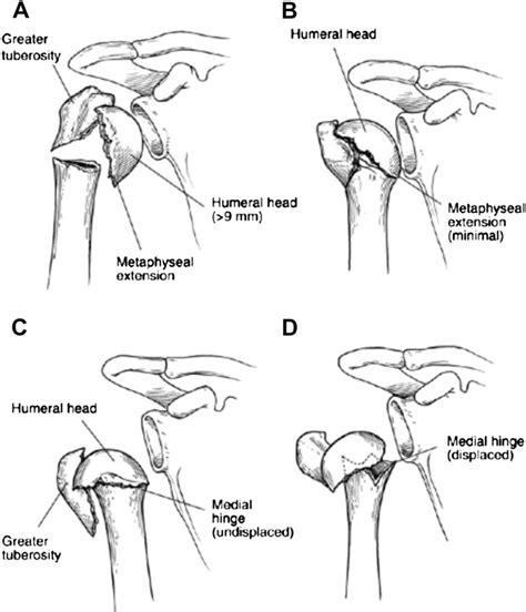 Types Of Proximal Humerus Fractures